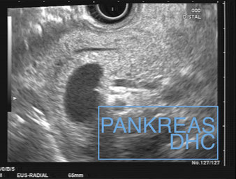 Endosonographie Normalbefund Pankreas DHC
