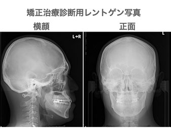 矯正用レントゲンセファロ