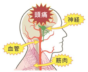 偏頭痛、片頭痛、緊張型頭痛、群発頭痛、慢性頭痛