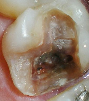 Emergency toothache