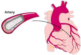 Infarto de miocardio
