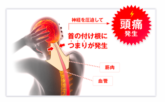 頭痛が発生していく様子を表した画像