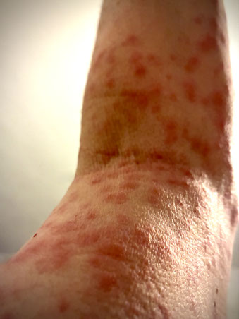 allergische Reaktion auf Antibiotika