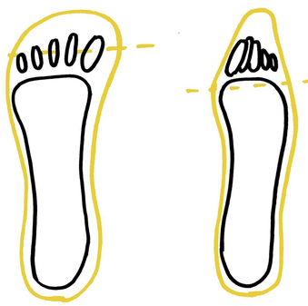 hallux valgus, voetklachten, minimalistische schoenen