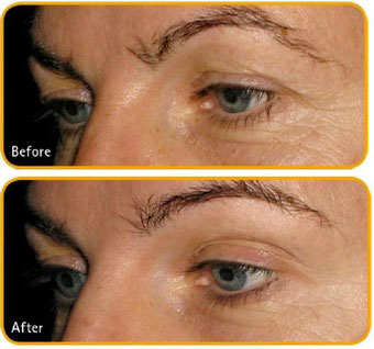 BeautyCollagenMatrix - Before - After