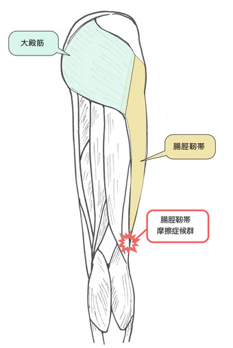 腸脛靭帯摩擦症候群