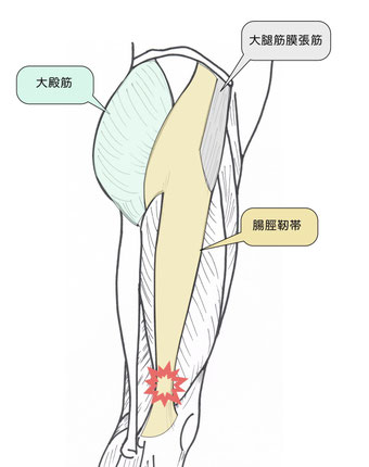 腸脛靭帯摩擦症候群