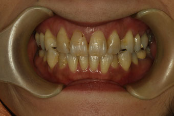 歯茎の退縮と歯の変色したケース