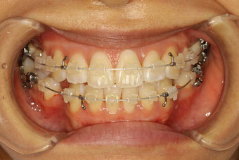 歯列矯正のモニター方の装置