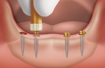 インプラント義歯の治療