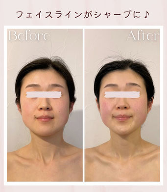 筋膜リリース　資格　ヘッド　ビフォーアフター