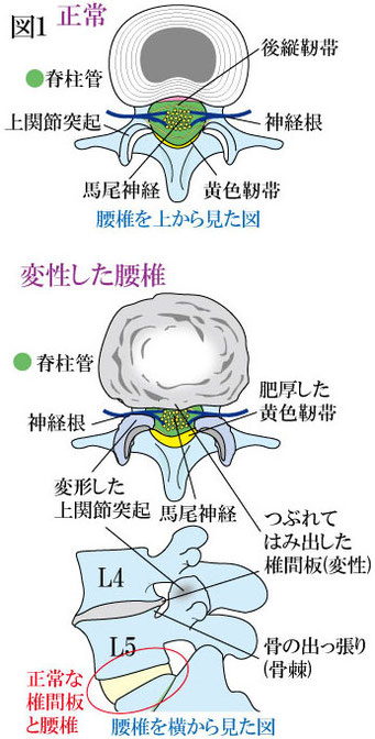 腰部脊柱管狭窄症