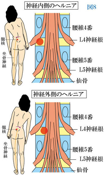 内側・外側ヘルニア