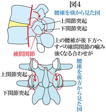 腰椎後方すべりと椎間関節