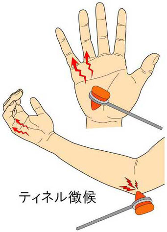 お歳暮ならオンライン 肘部管症候群とギヨン管症候群 - やまだカイロプラクティック 医学一般