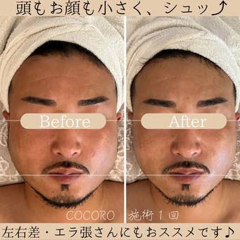 小顔 骨格矯正 ビフォーアフター