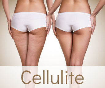 Cellulite Behandlung Behandlung von Orangenhaut bei Christina Friess Studio in Stuttgart