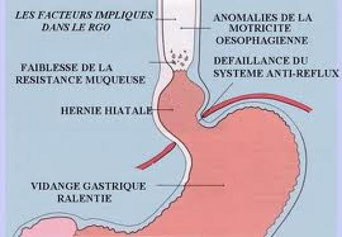 Reflux Gastro Oesophagien ? Francis NYOCK, ostéopathe D.O. spécialiste de la voix ( à Lyon et à Albigny sur Sâone)