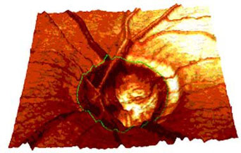 Topografie der Papille, hier die 3D-Darstellung im HRT3; die anschließende Datenanalyse ermöglicht ein frühzeitiges Erkennen von Schäden am Sehnerven