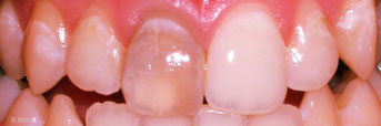 Dunkel verfärbter Zahn mit abgestorbenem Zahnnerv