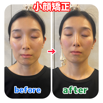 葛飾区立石ひだまり整骨院の小顔矯正ビフォーアフターの画像