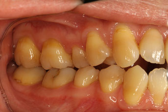 奥歯の歯ぐき退縮