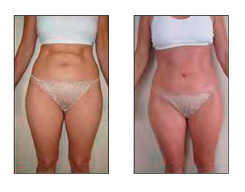 bioslimming antes y después