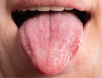 Die Zunge kann viele Hinweise auf den Stoffwechsel geben.