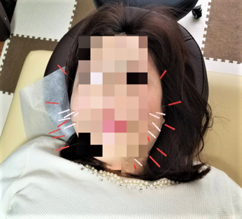 小牧市 はりきゅう はり治療 自律神経 頭痛 腰痛 肩こり 美容鍼