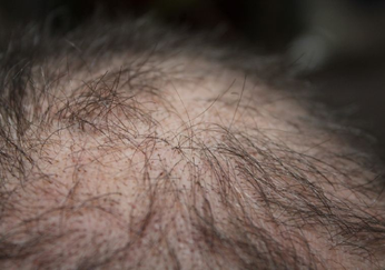 Auch Haarausfall kann ein mögliches Symptom von langfristigen Gesundheitsproblemen sein, die nach einer COVID-19-Erkrankung auftreten können.