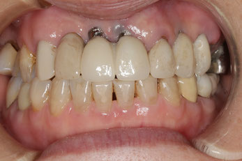 インプラント部分の歯茎再生