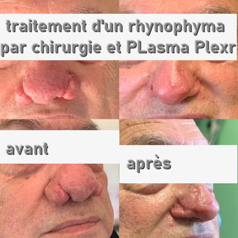 www.jolyvisage.com plasma Plexr du nez