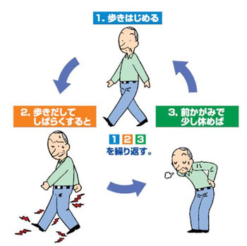 間欠性跛行は、①歩く→②痛みが出る→③前かがみで休むを繰り返す