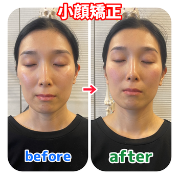葛飾区立石ひだまり整骨院の小顔矯正ビフォーアフターの画像
