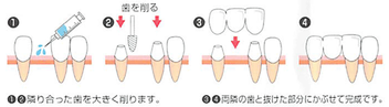 八戸市の接着ブリッジ　くぼた歯科