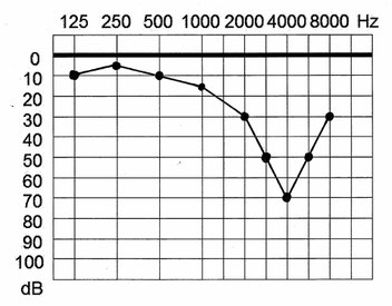 Tonaudiogramm eines durch Lärm Hörgeschädigten (c5-Senke)