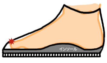 つま先が靴に当たっています 指が曲がったり、爪が変色することも