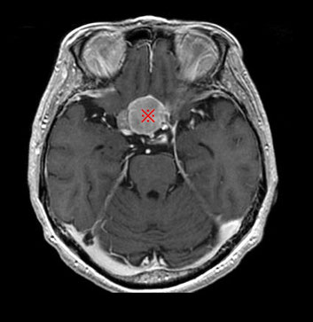 右目がほぼ失明した状態で手術を行なった６２歳女性の髄膜腫の症例　術前頭部MRI画像