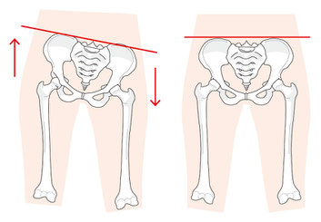 骨盤が歪んで坐骨神経痛が発症