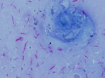 写真：結核患者の喀痰の塗抹検体の抗酸性染色（西山先生撮影）