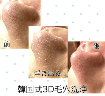 韓国式3D毛穴洗浄 - 名古屋市千種区池下 エステ「リファイン