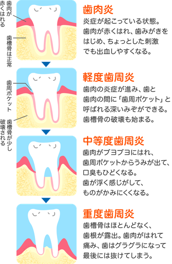 歯肉炎に効く食べ物 シャキット 札幌にあるレッドコード完備のフィットネス
