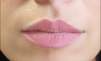 natürliche Betonung des Lippenherzens nach 2 Mini-Dosen Botulinum als "Lip Flip"