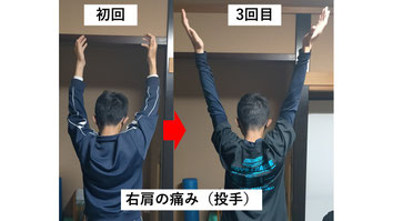野球肩の肩関節可動域を検査し施術前後の変化を確認する様子