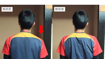 野球肩の原因や身体の状態をわかりやすく説明