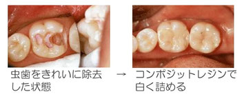 白い詰め物　CR　充填　インレー