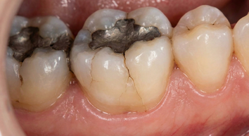 Cracked Tooth Syndrome (CTS) durch Zähneknirschen, empfohlen: Knirschschiene 
