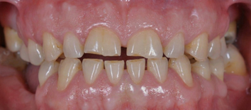 Cracked Tooth Syndrome (CTS) durch Zähneknirschen, empfohlen: Knirschschiene