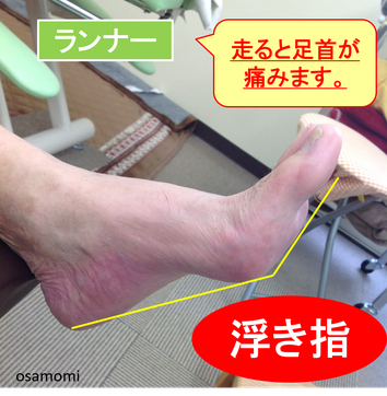 浮き指ランナーは、足首痛・ハムスト肉離れになりやすい!昭島市のオサモミ整体院