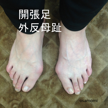 オサモミ整体院 外反母趾 開張足